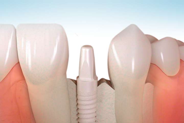 Keramikimplantate