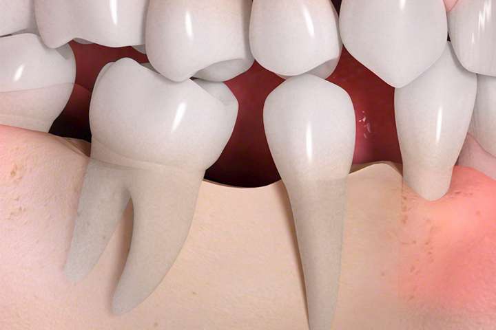 Folgen von Zahnverlust